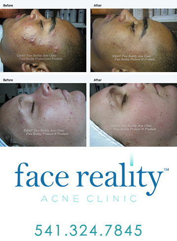 Face Reality Acne Specialist